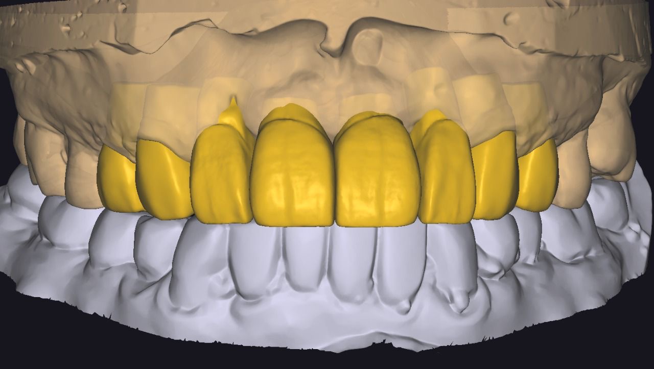 Diseño digital CAD-CAM de restauraciones dentales sobre modelos virtuales